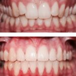 Before and After Braces_ Actual Patient of our…