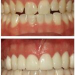 Before and after porcelain veneers #Augusta…