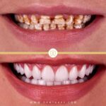 Hollywood Smile Before and After